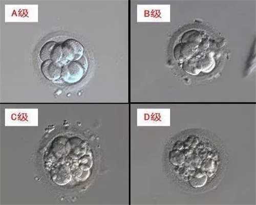 徐州试管婴儿：为什么多囊卵巢综合征患者需要